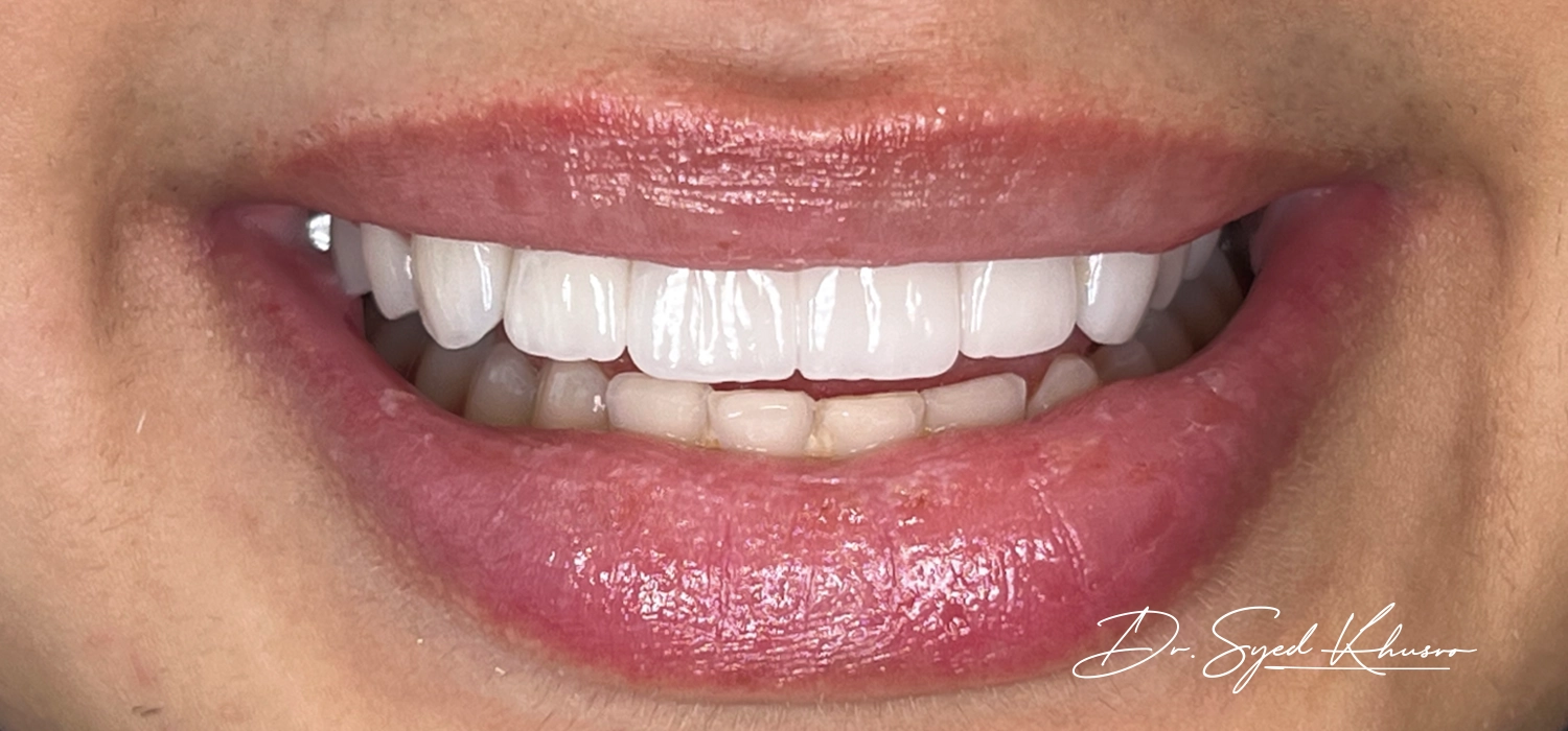 What Are The Advantages Of Full Mouth Dental Implants?